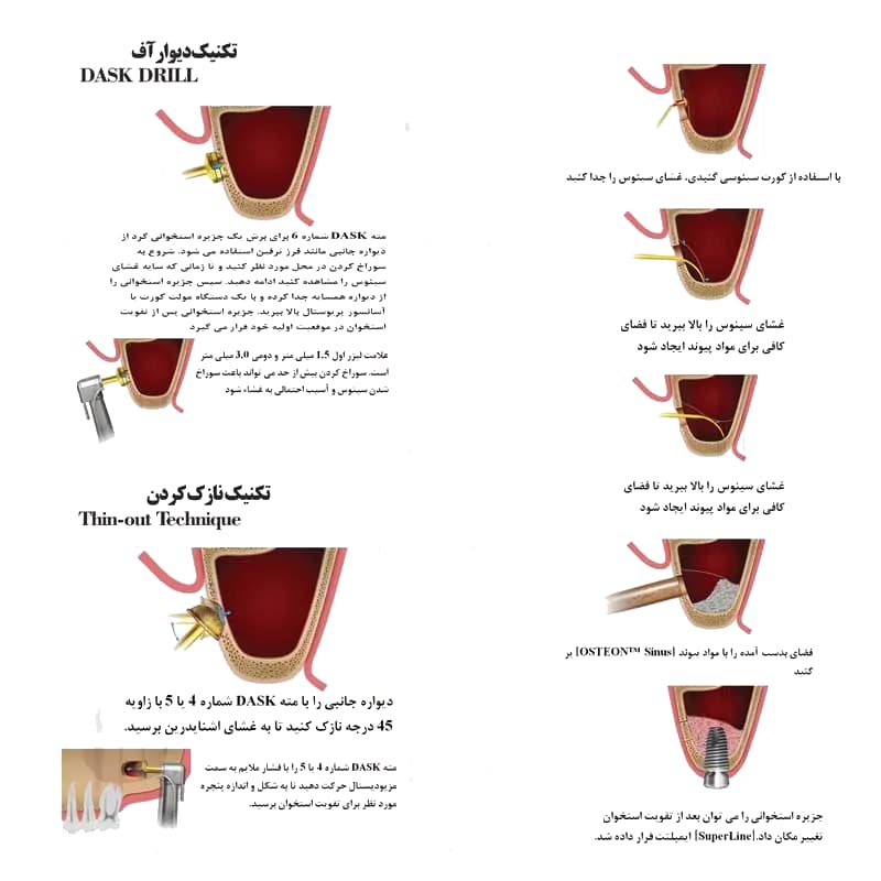کیت پیشرفته سینوس لیفت اوپن و کلوز کاریزما – 15 عددی – Open & Close Sinus Lift — تصویر ۱۱