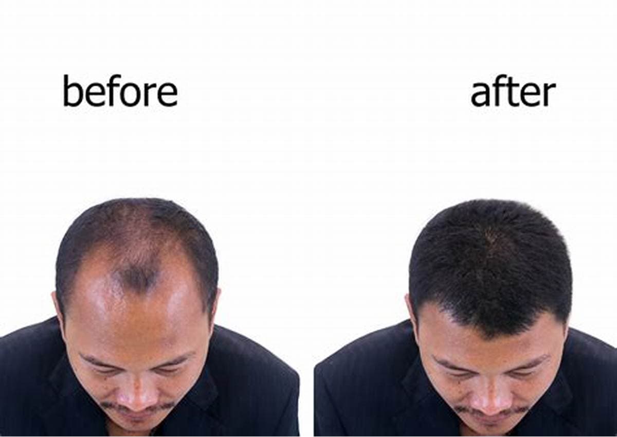 کوکتل ضد ریزش مو و تقویت کننده برند رویتاکر مدل هیرکر Revitacare — تصویر ۷