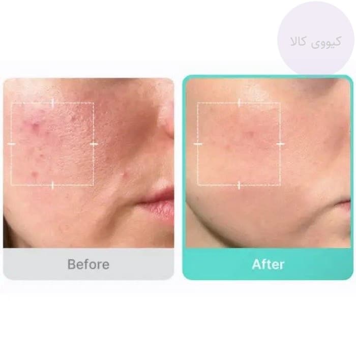 سرم آزلائیک اسید 16% مدی کیوب Medicube تسکین دهنده و ضد جوش — تصویر ۶