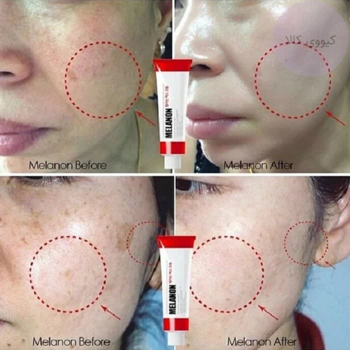 کرم ملانون ایکس melanon x مدی پیل Medi Peel ضد لک و روشن کننده — تصویر ۱۱