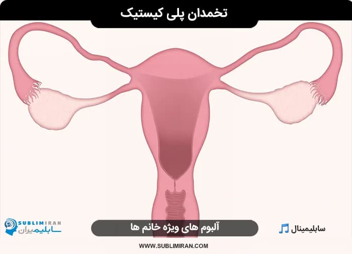 تخمدان پلی کیستیک — تصویر ۲