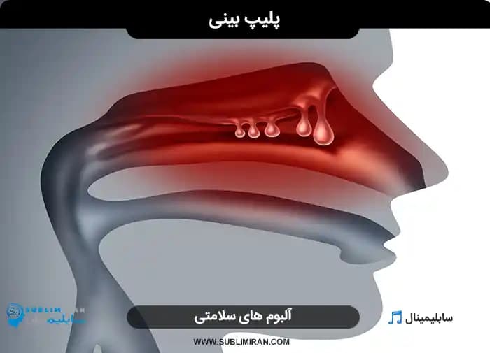 پلیپ بینی