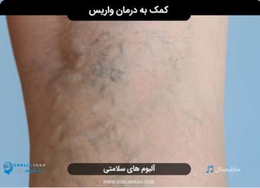 درمان واریس — تصویر ۲