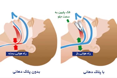 دیوایس دهانی خروپف — تصویر ۱۰