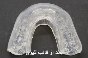 دیوایس دهانی خروپف — تصویر ۶