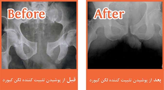 تثبیت کننده آنی لگن بعد از ترما(T-POD) — تصویر ۳