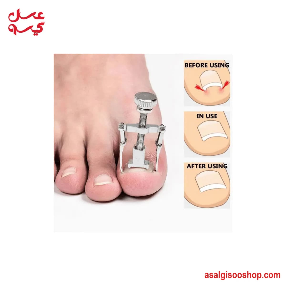 ارتونیل ناخن ارتودنسی درجه یک |Orthonyxia Nail Correction Tool (Orthonil) | کد 3186