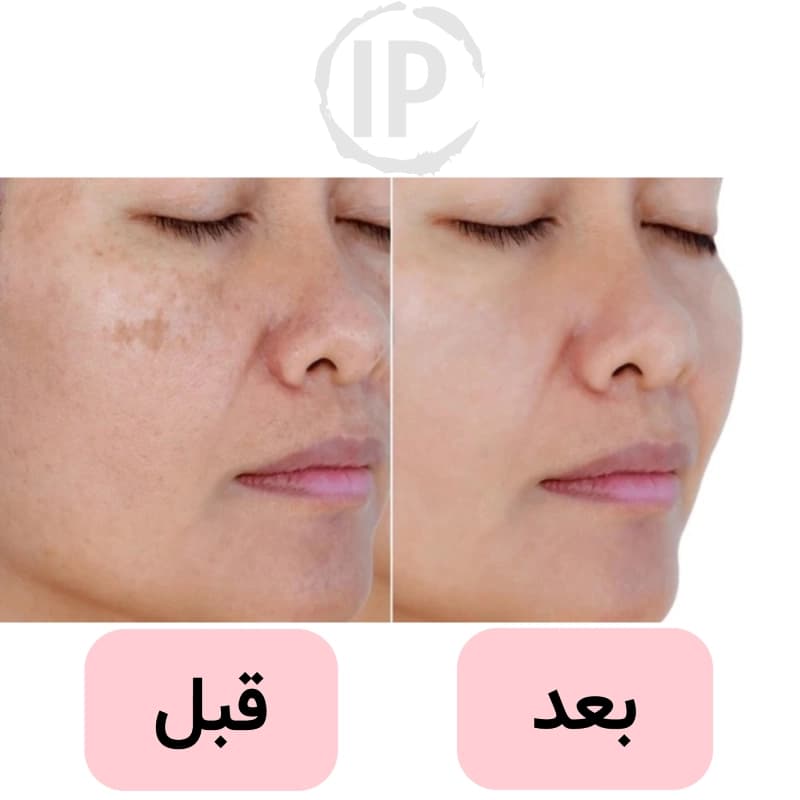 کرم سفید کننده صورت و نواحی تیره زنیکس 70 میل — تصویر ۳