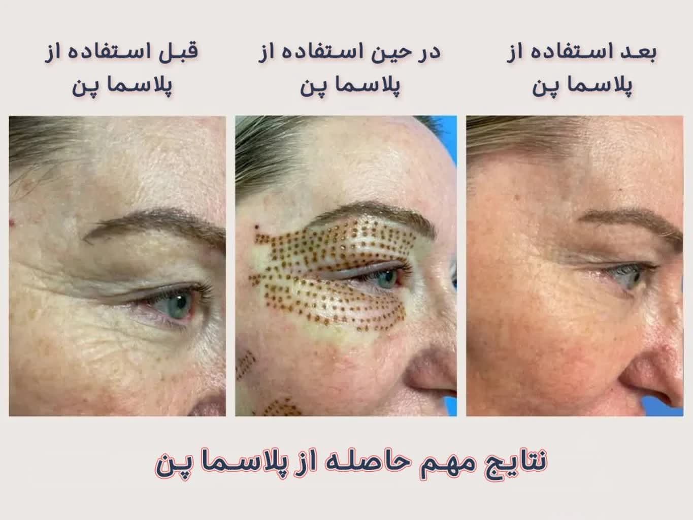 دستگاه پلاسما پن فیوژن PAA — تصویر ۷