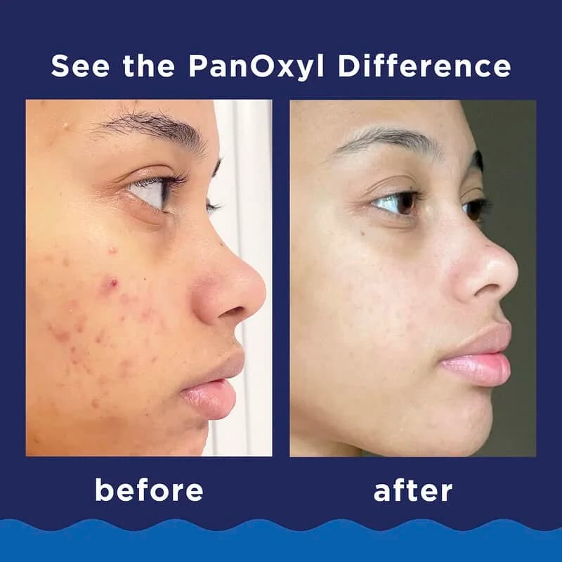 فوم شوینده ضد جوش پانوکسیل 10% بنزوئیل پروکساید PanOxyl | اصل — تصویر ۲