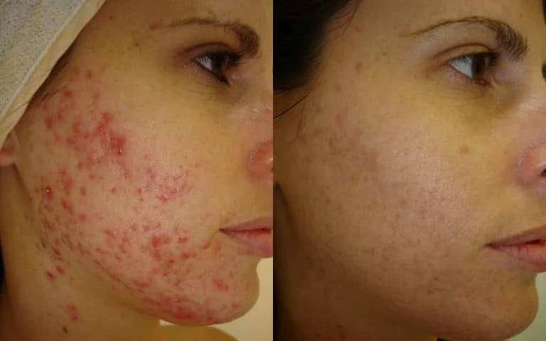 ژل ضد جوش دیفرین مدل Adapalene حجم 30 میلی لیتر — تصویر ۹