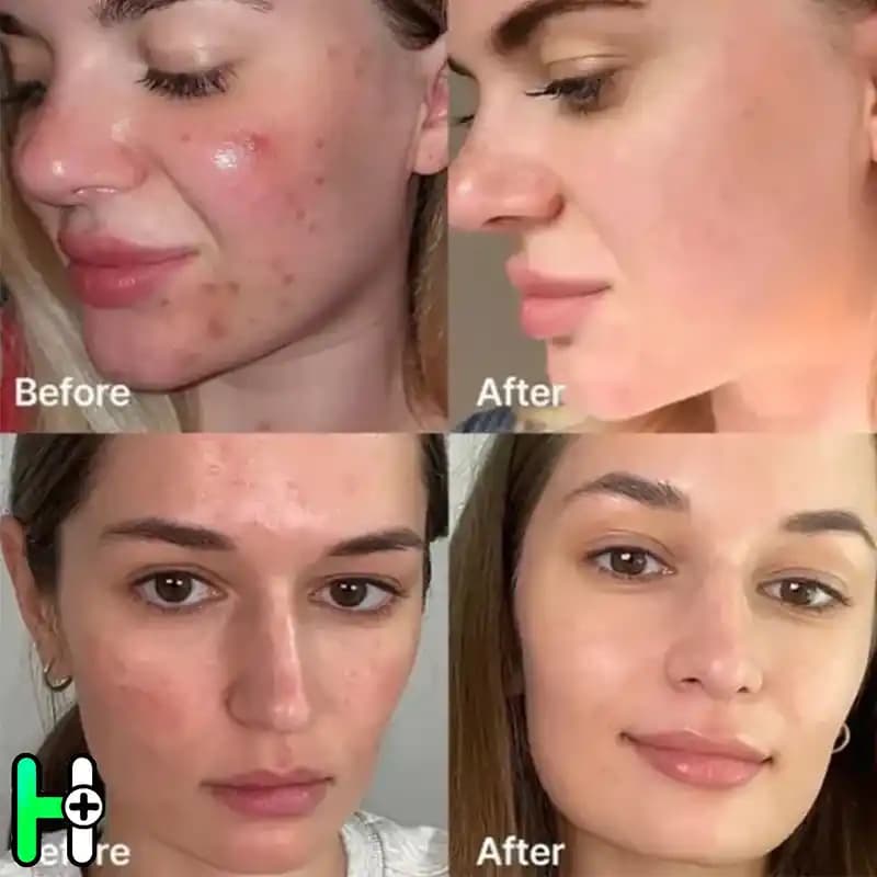 سرم پیلینگ سوکسینیک اسید لایه‌بردار و ضدجوش قوی مدی کیوب Medicube Red Succinic Acid Peel — تصویر ۵