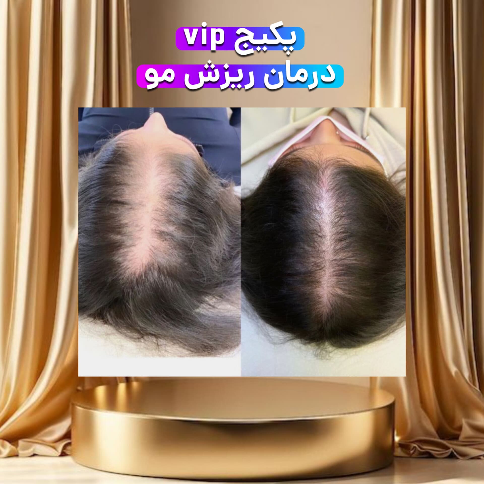 درمان vipریزش مو رویش(۲ماهه) — تصویر ۳