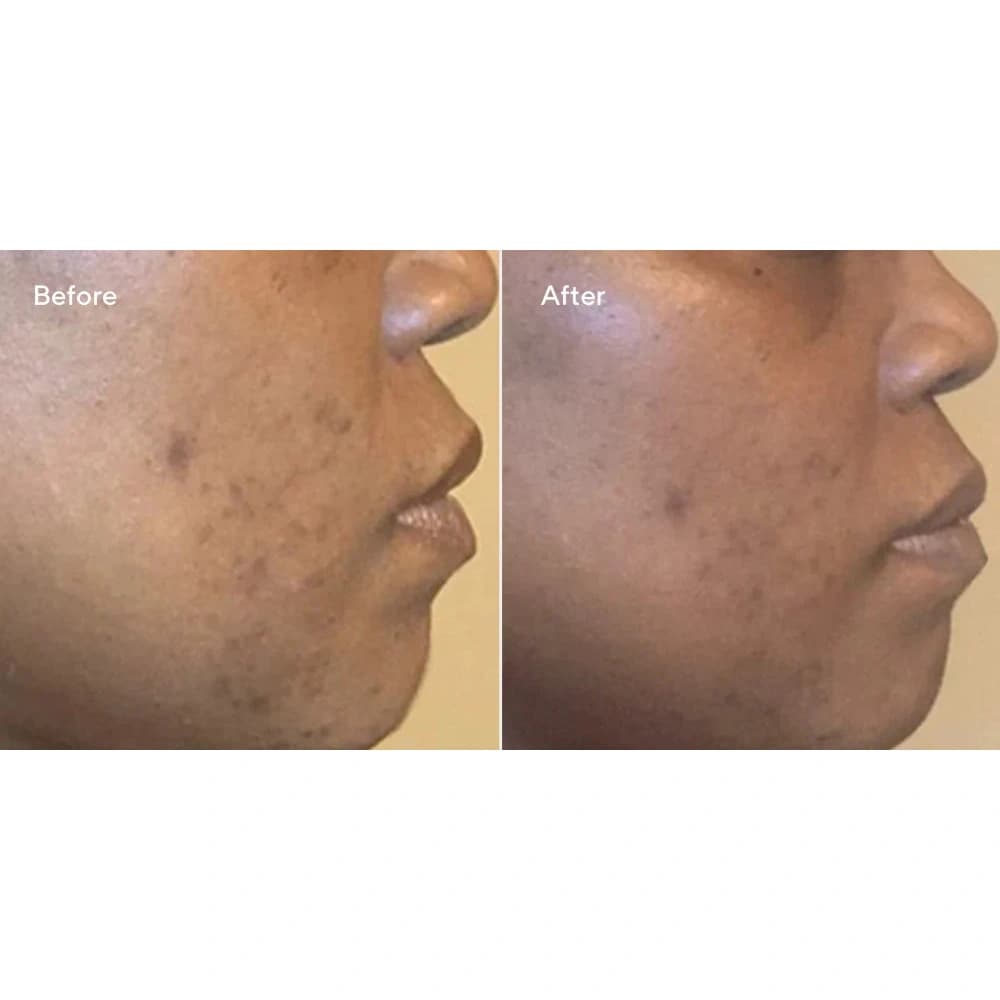 سرم ضد آفتاب ضد لک SPF45 دکتر مورد — تصویر ۵