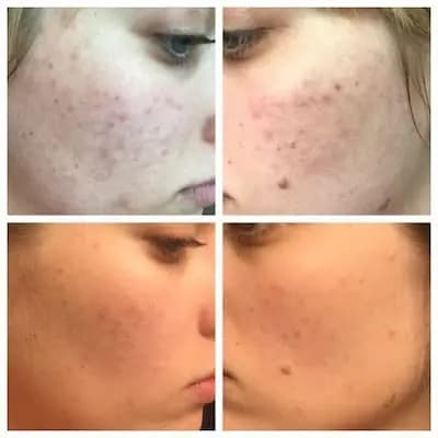 بوستر ضدلک آزلائیک اسید ۱۰٪ پائولاز چویس فول سایز 30ml — تصویر ۴