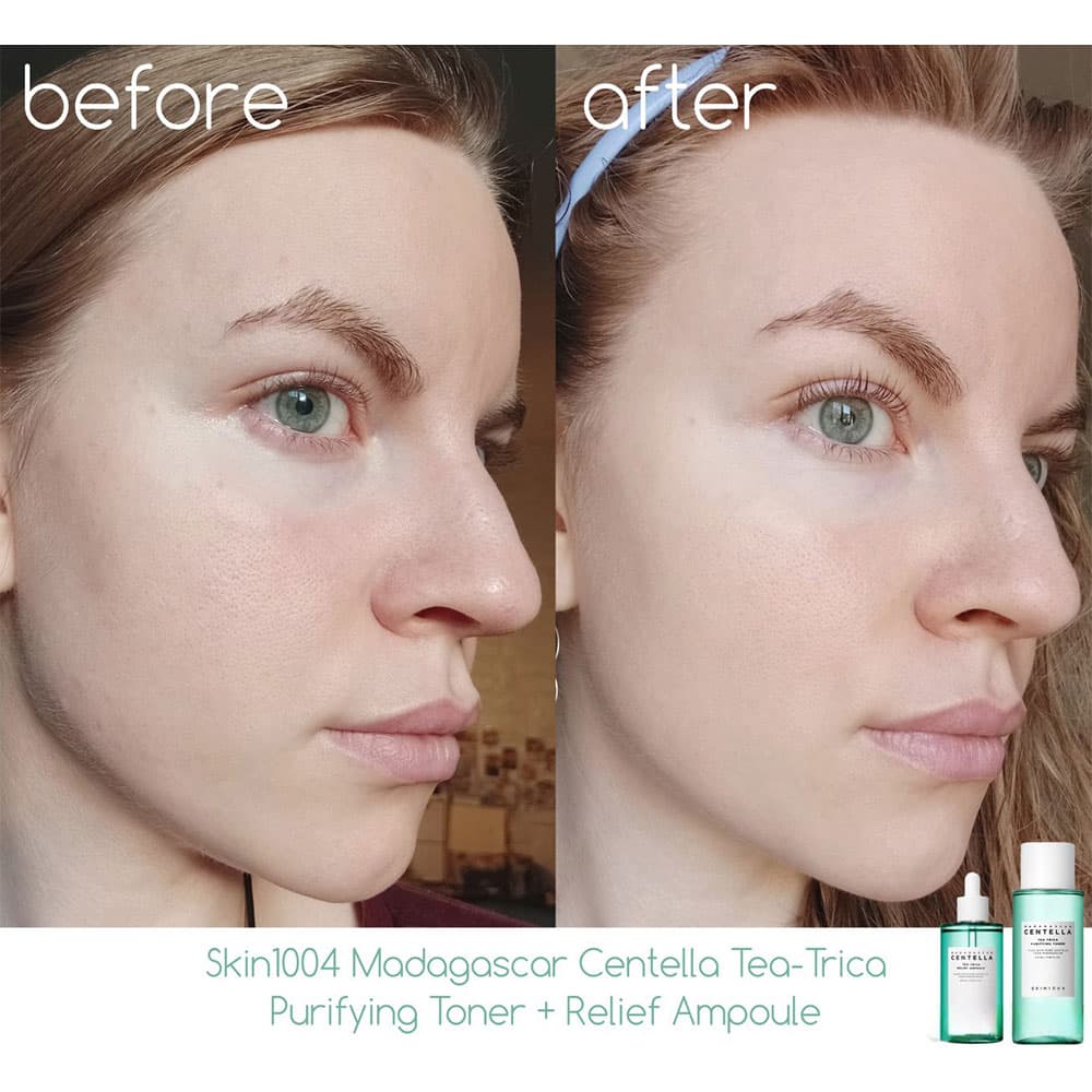 تونر ضد جوش و پاک کننده صورت چای تریکا سنتلا ماداگاسکار اسکین SKIN1004 حجم 210 میل — تصویر ۴