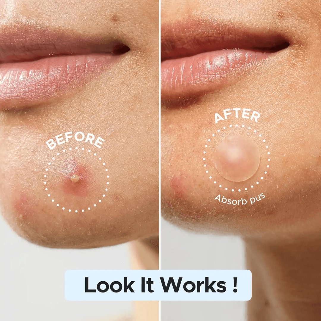 پچ جوش برند اکنه پچ acne patch مدل t11 بسته 36 عددی — تصویر ۸