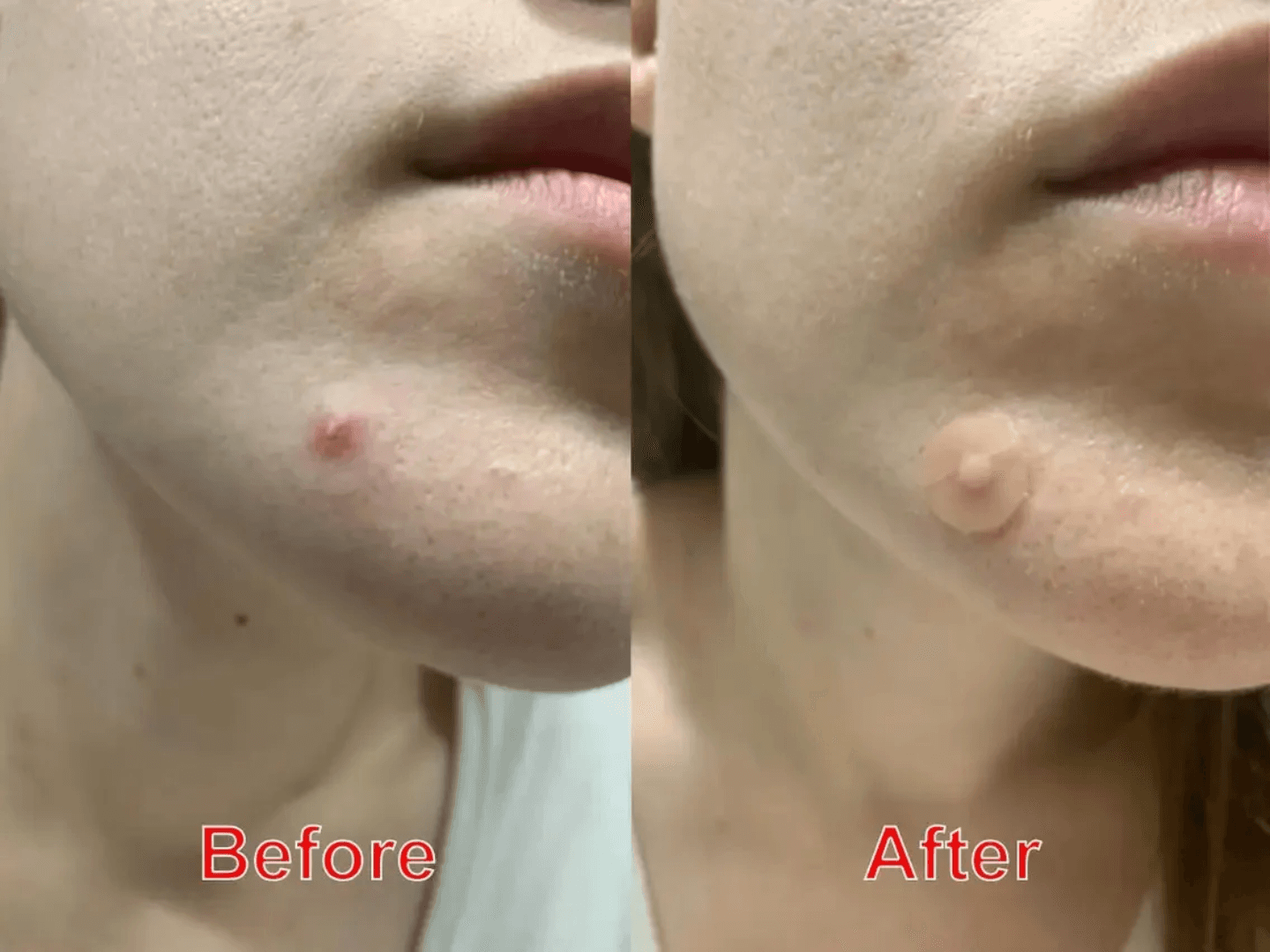 پچ جوش برند اکنه پچ acne patch مدل t11 بسته 36 عددی — تصویر ۴