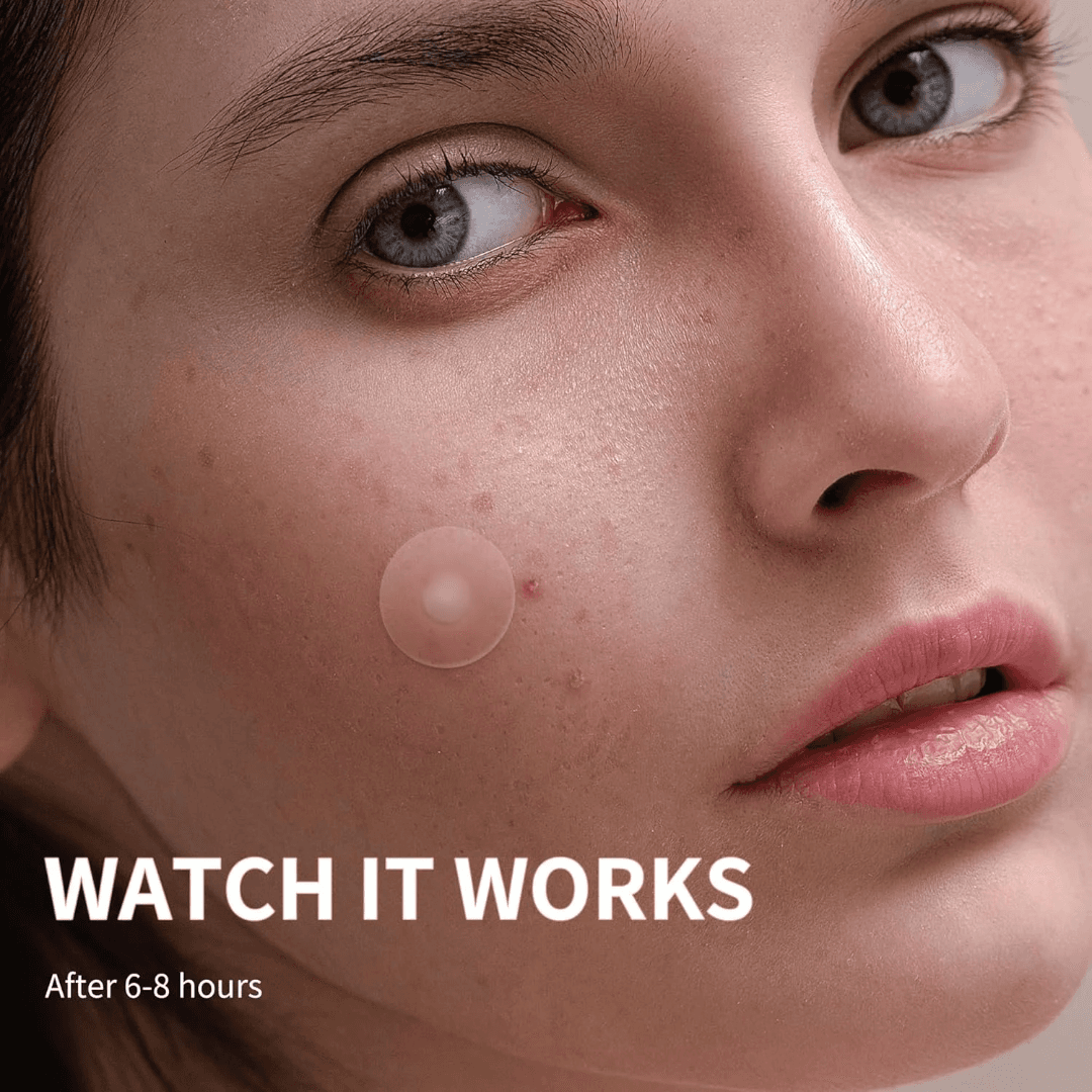 چسب جوش برند اکنه پچ acne patch مدل t11 بسته 36 عددی — تصویر ۴