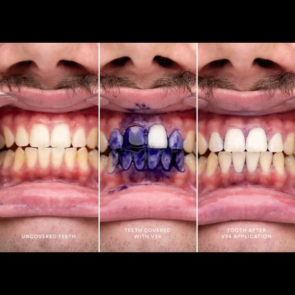 ژل سفید کننده دندان فوری V34 glory smile — تصویر ۳