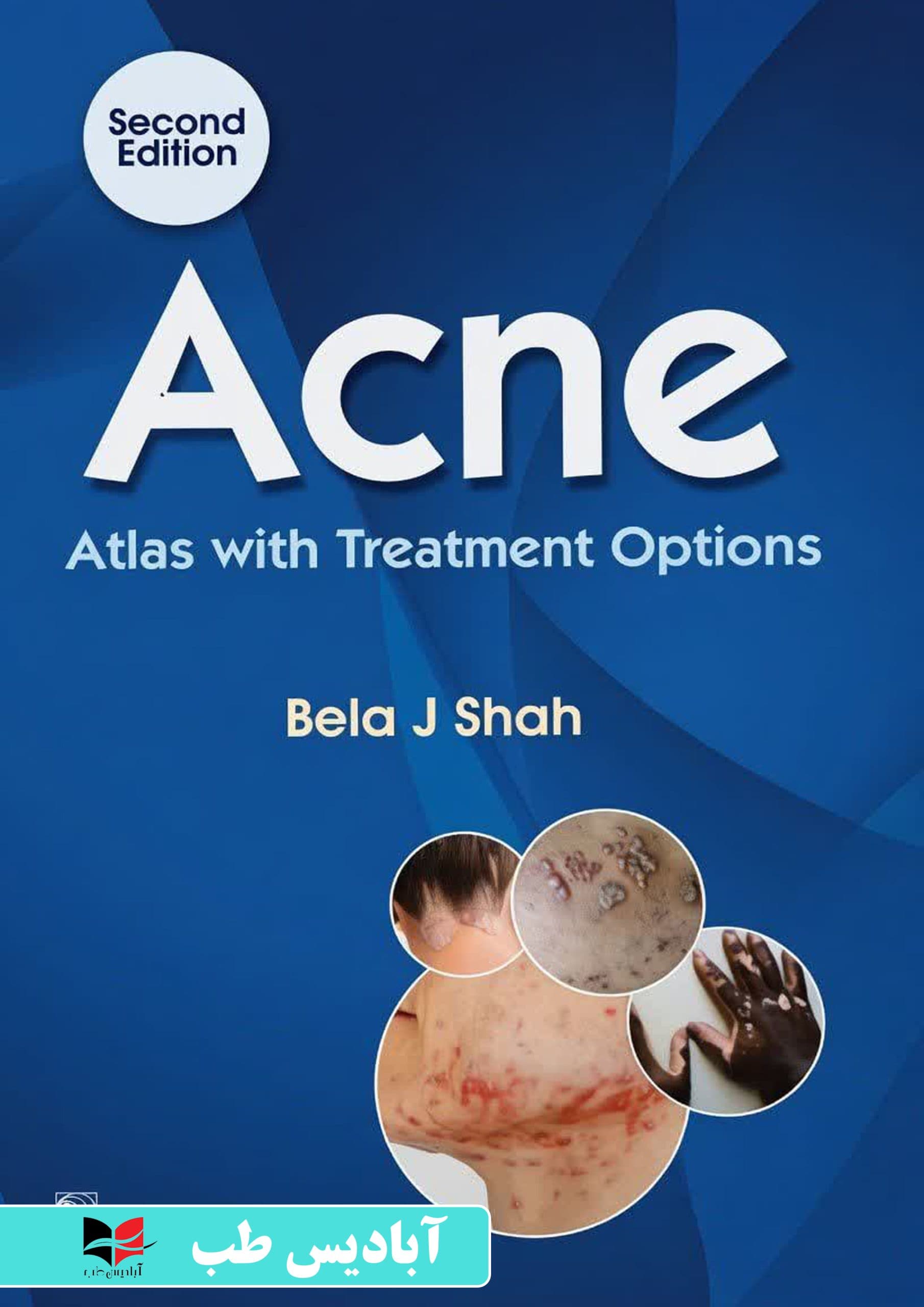 Acne Atlas with Treatment Options | اطلس آکنه با گزینههای درمانی