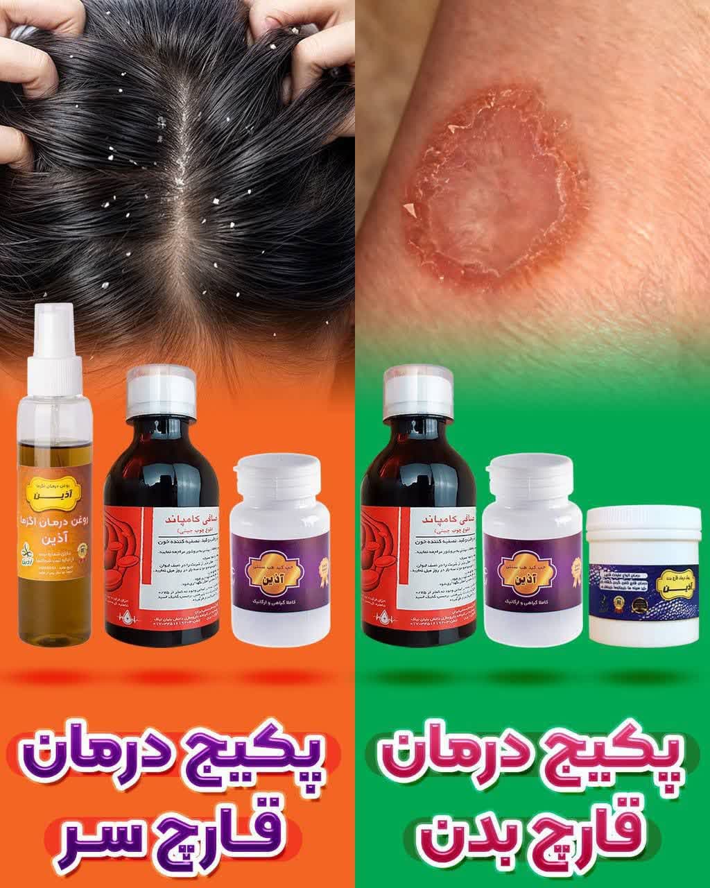 پکیج درمان قارچ بدن و سر
