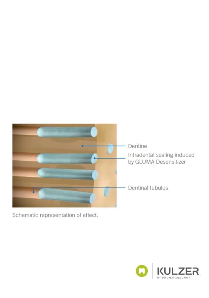 مایع ضد حساسیت کولزر Gluma Desensitizer kulzer — تصویر ۲