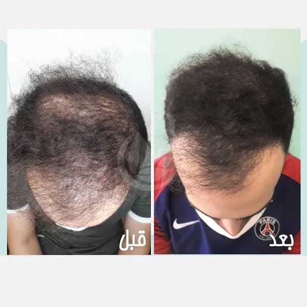پک 5 عددی کوکتل هیر من مزولایک — تصویر ۲