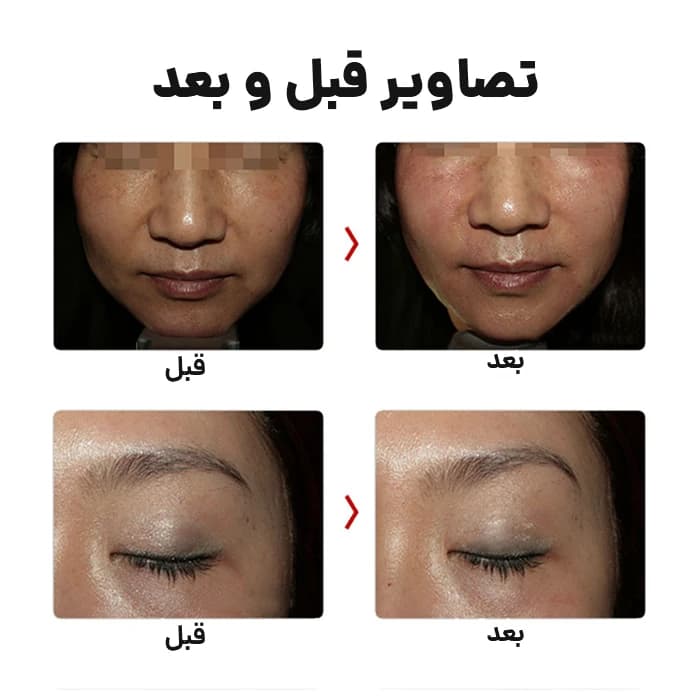 دستگاه هایفو گلد پریمیوم – Haifu Gold Premium — تصویر ۷
