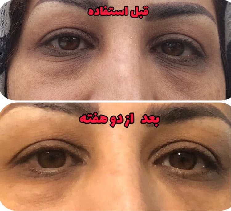 پک تخصصي دور چشم