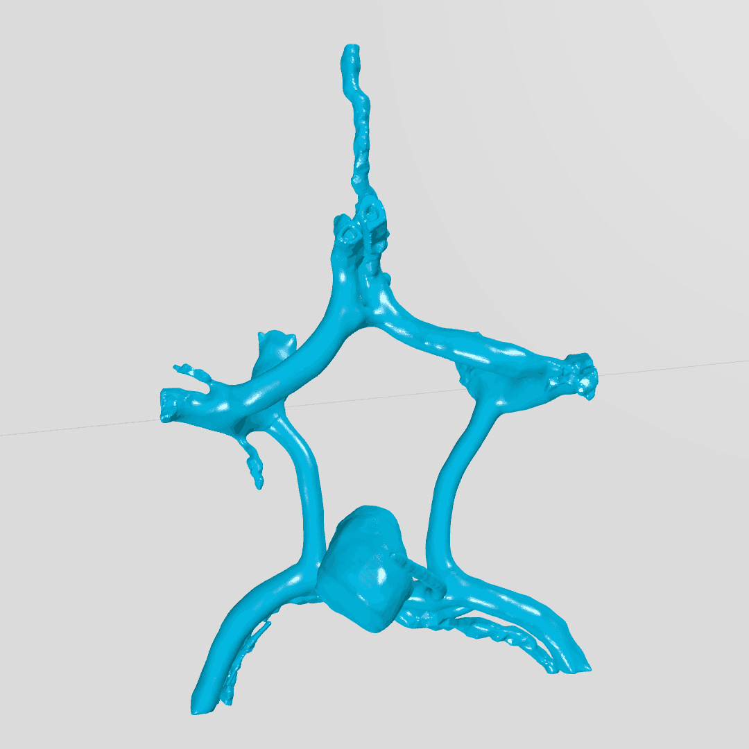 آنوریسم حلقه ویلیس (circle of willis aneurysm)