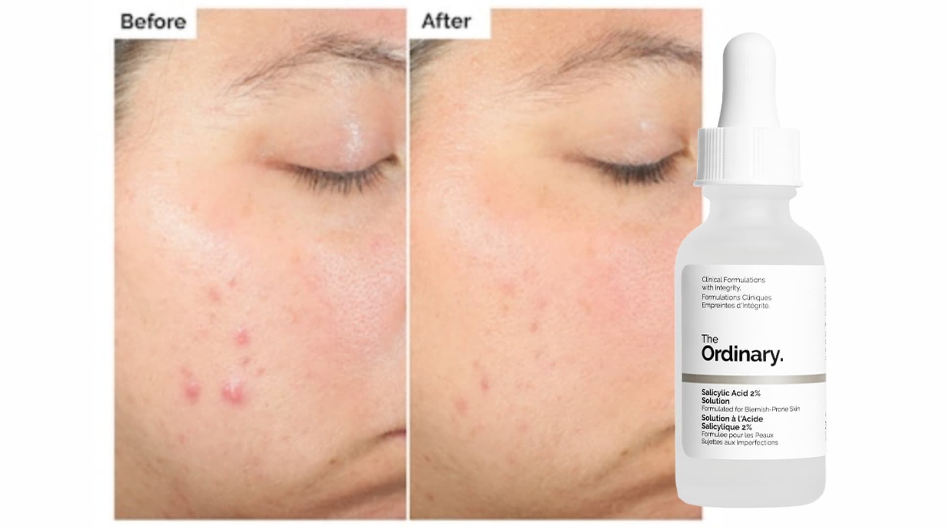 سرم لایه بردار و ضد جوش سالیسیلیک اسید 2% اوردینری The Ordinary — تصویر ۲