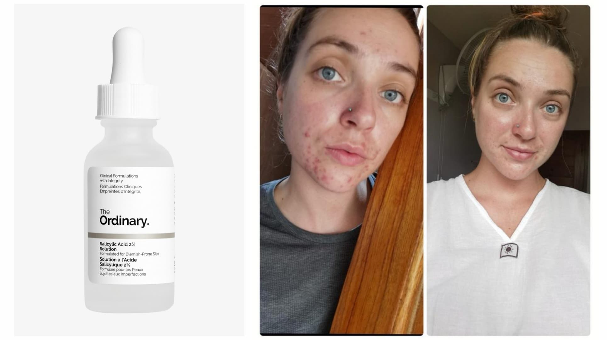 سرم لایه بردار و ضد جوش سالیسیلیک اسید 2% اوردینری The Ordinary — تصویر ۴