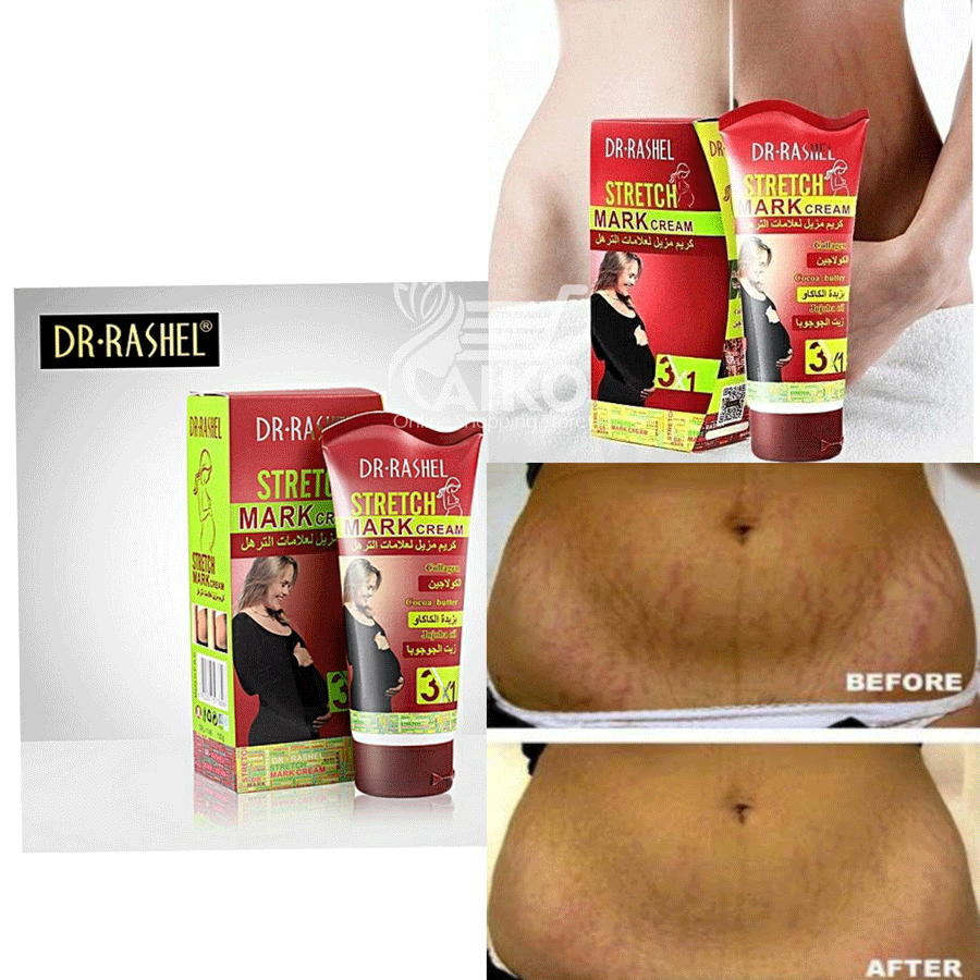 کرم رفع ترک شکم بعد از زایمان دکترراشل DR.RASHEL — تصویر ۷