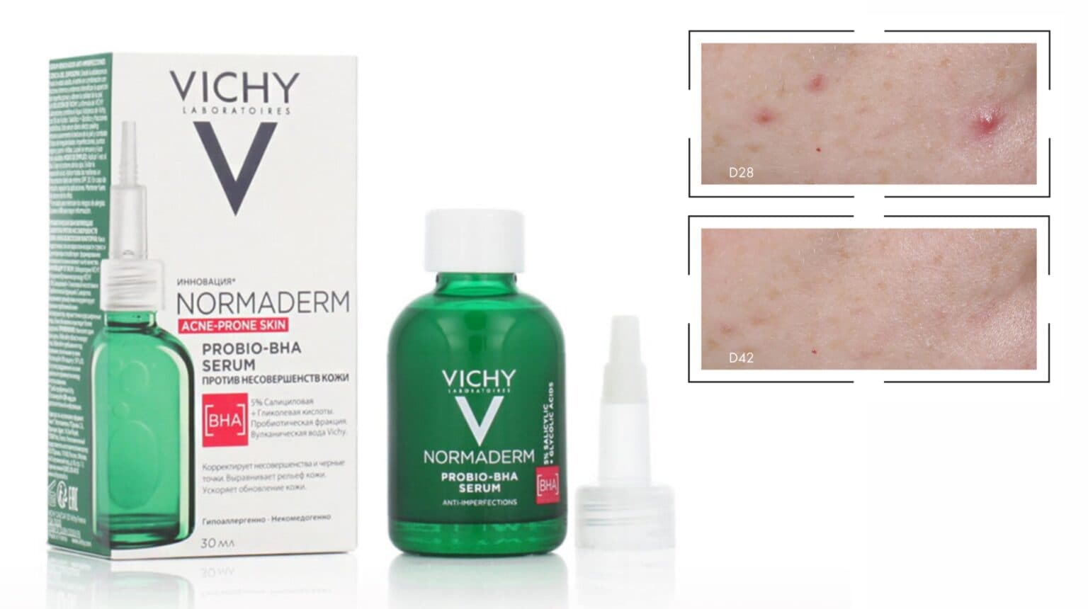 سرم ضد جوش و آکنه نورمادرم ویشی VICHY حجم 30 میلی لیتر — تصویر ۶