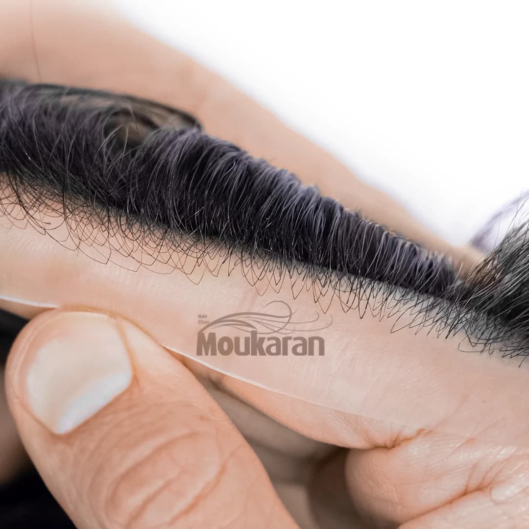 پروتز مو دور سیلیکونی — تصویر ۳