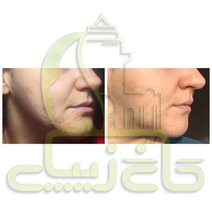 تونر ضد جوش و آبرسان 30 روزه میراکل سام بای می 150 میل اصل — تصویر ۳