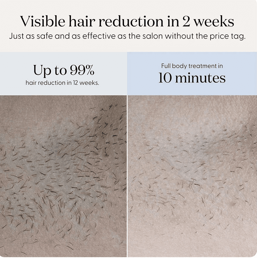 لیزر خانگی Smoothskin Pure — تصویر ۳