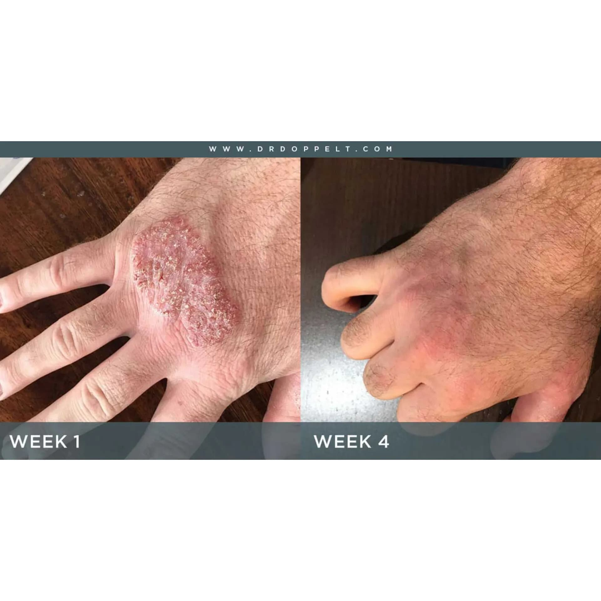 کرم ترمیم کننده اون سیکالفیت پلاس Cicalfate+ حجم 40 میل — تصویر ۷