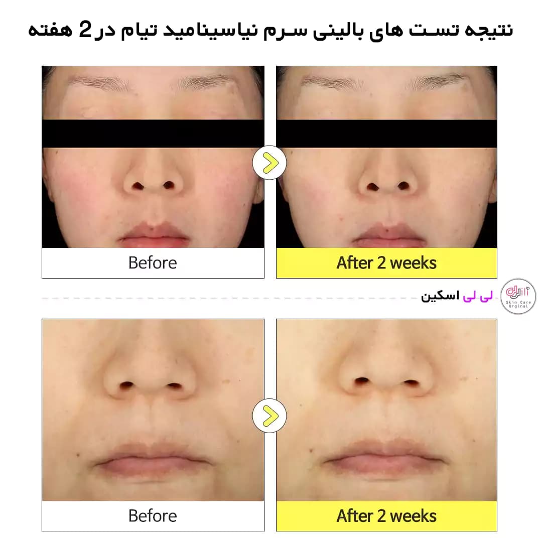 سرم ضدلک نیاسینامید تیام — تصویر ۵
