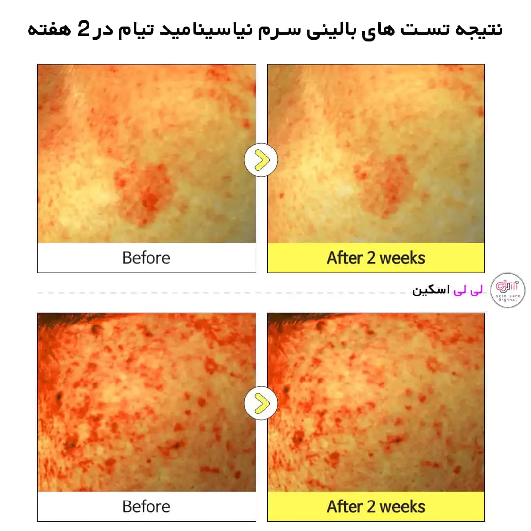 سرم ضدلک نیاسینامید تیام — تصویر ۶