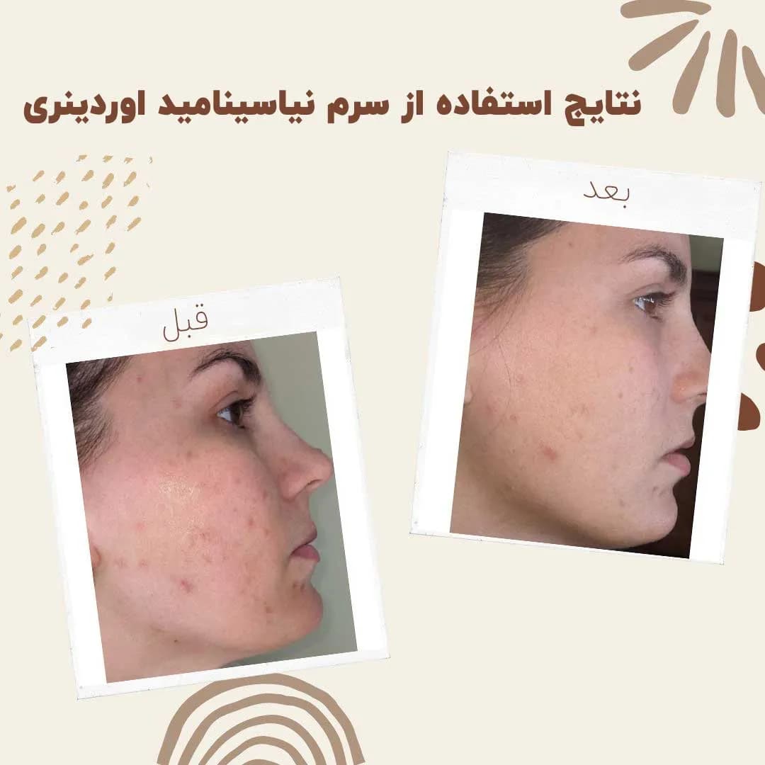سرم نیاسینامید اوردینری 10% + زینک 1% | کنترل چربی و کاهش جوش — تصویر ۳
