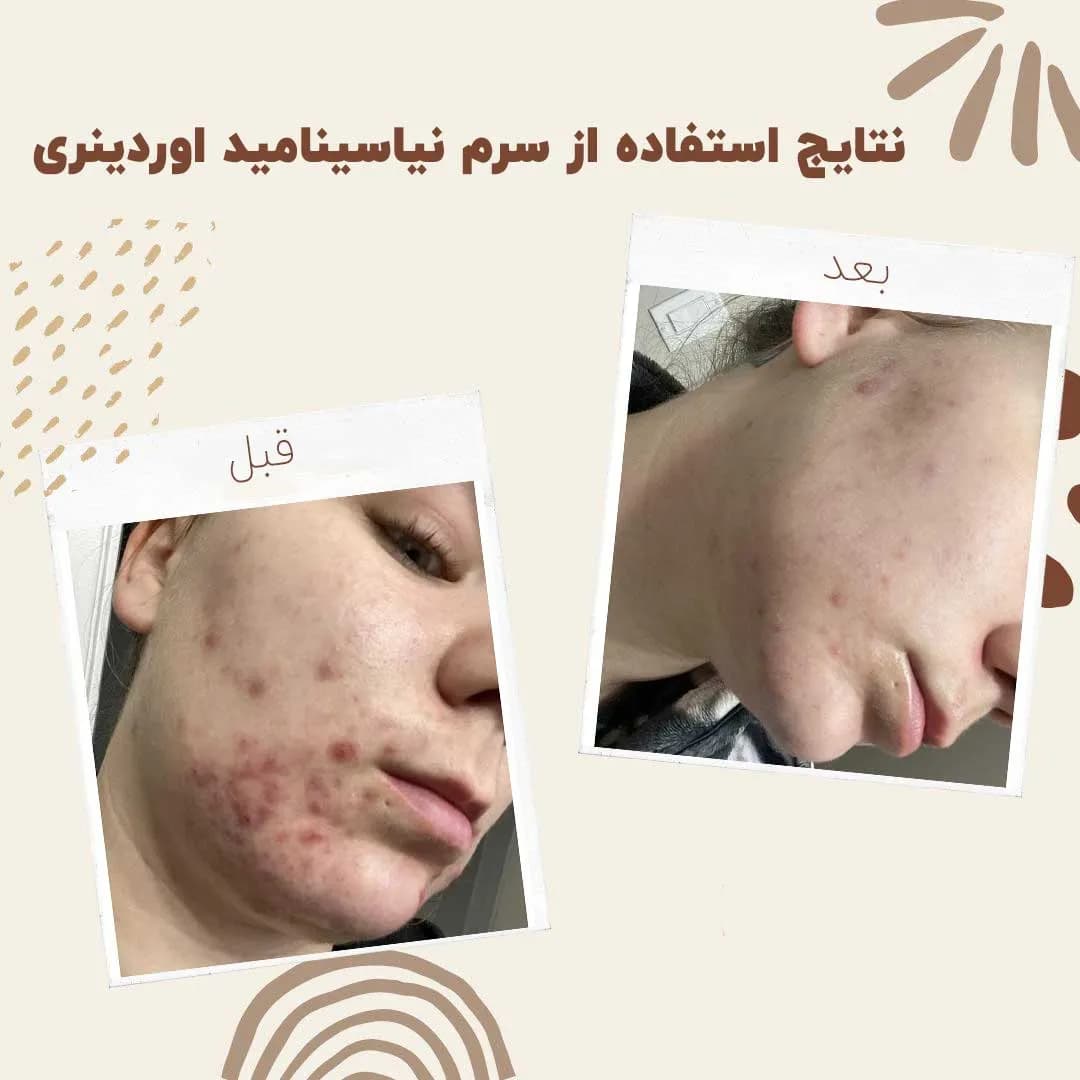سرم نیاسینامید اوردینری 10% + زینک 1% | کنترل چربی و کاهش جوش — تصویر ۴