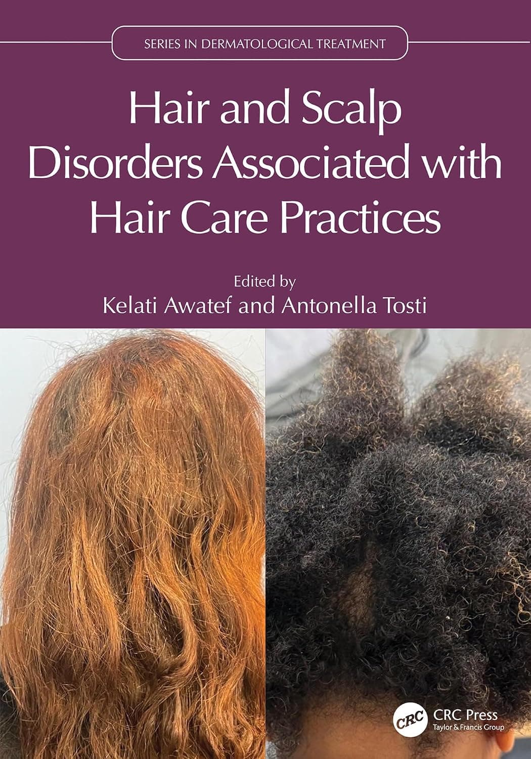 دانلود کتاب Hair and Scalp Disorders Associated with Hair Care Practices (Series in Dermatological Treatment)