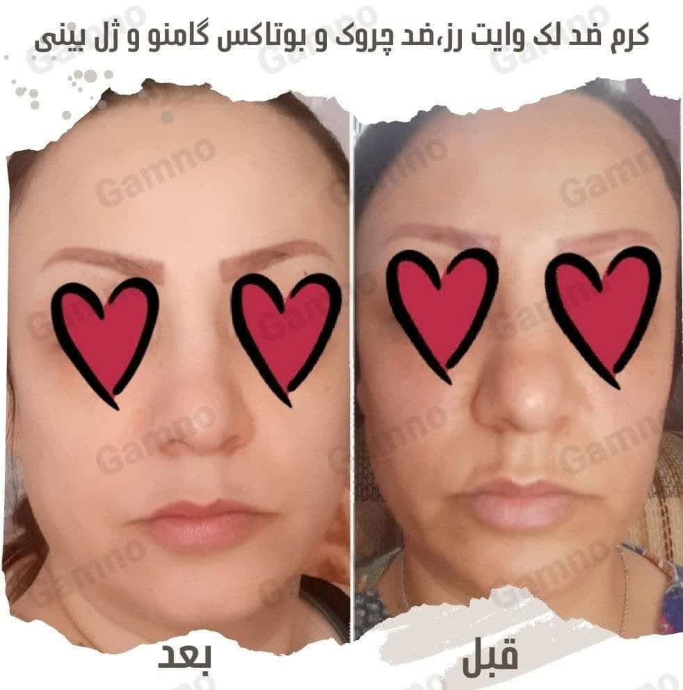 ژل کوچک کننده بینی گامنو | (Gamno Nose Slimming Gel) — تصویر ۳