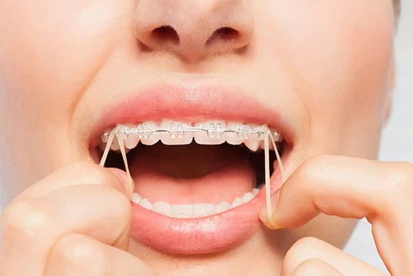 کش الاستیک ارتودنسی
