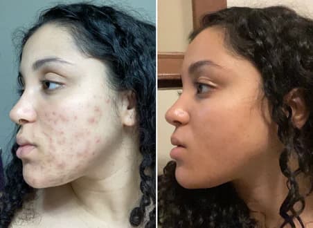 ژل ضدجوش دیفیرین وزن 30 گرم — تصویر ۲