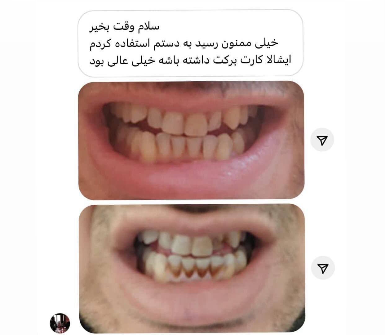 پودر جرم گیر دندان اونیس — تصویر ۴
