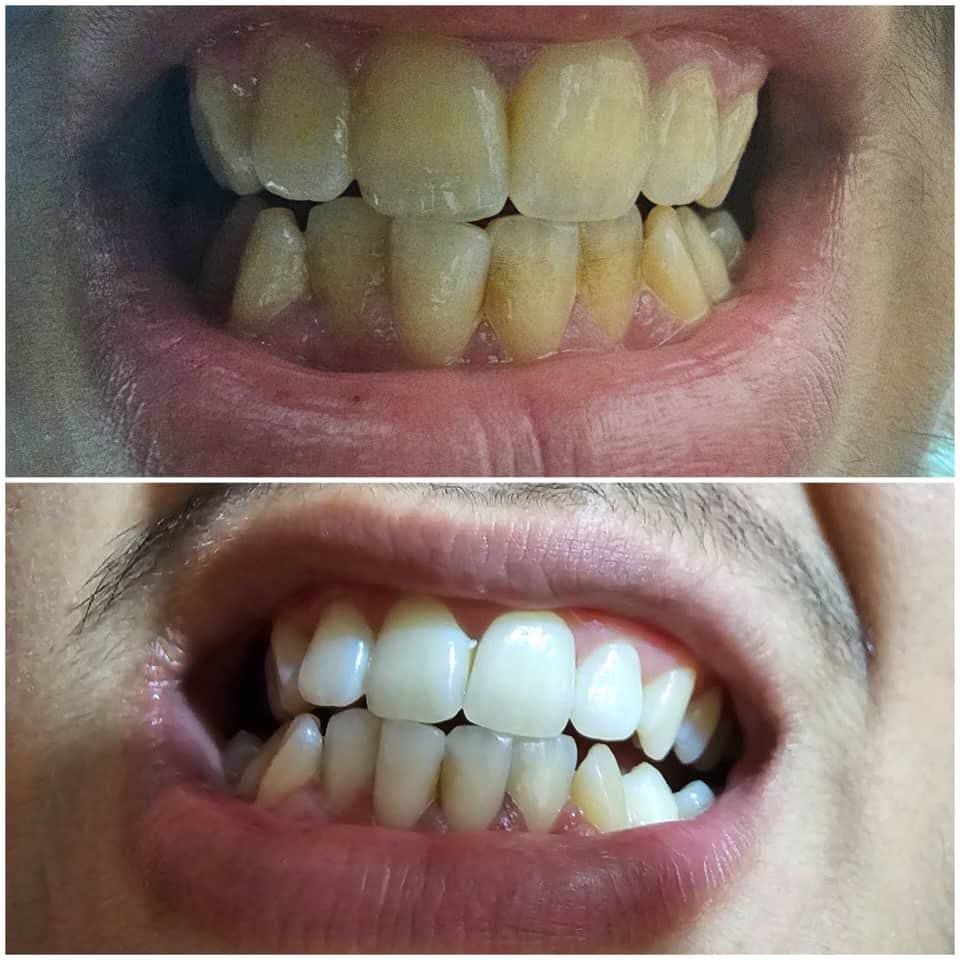 پودر جرم گیر دندان اونیس — تصویر ۲