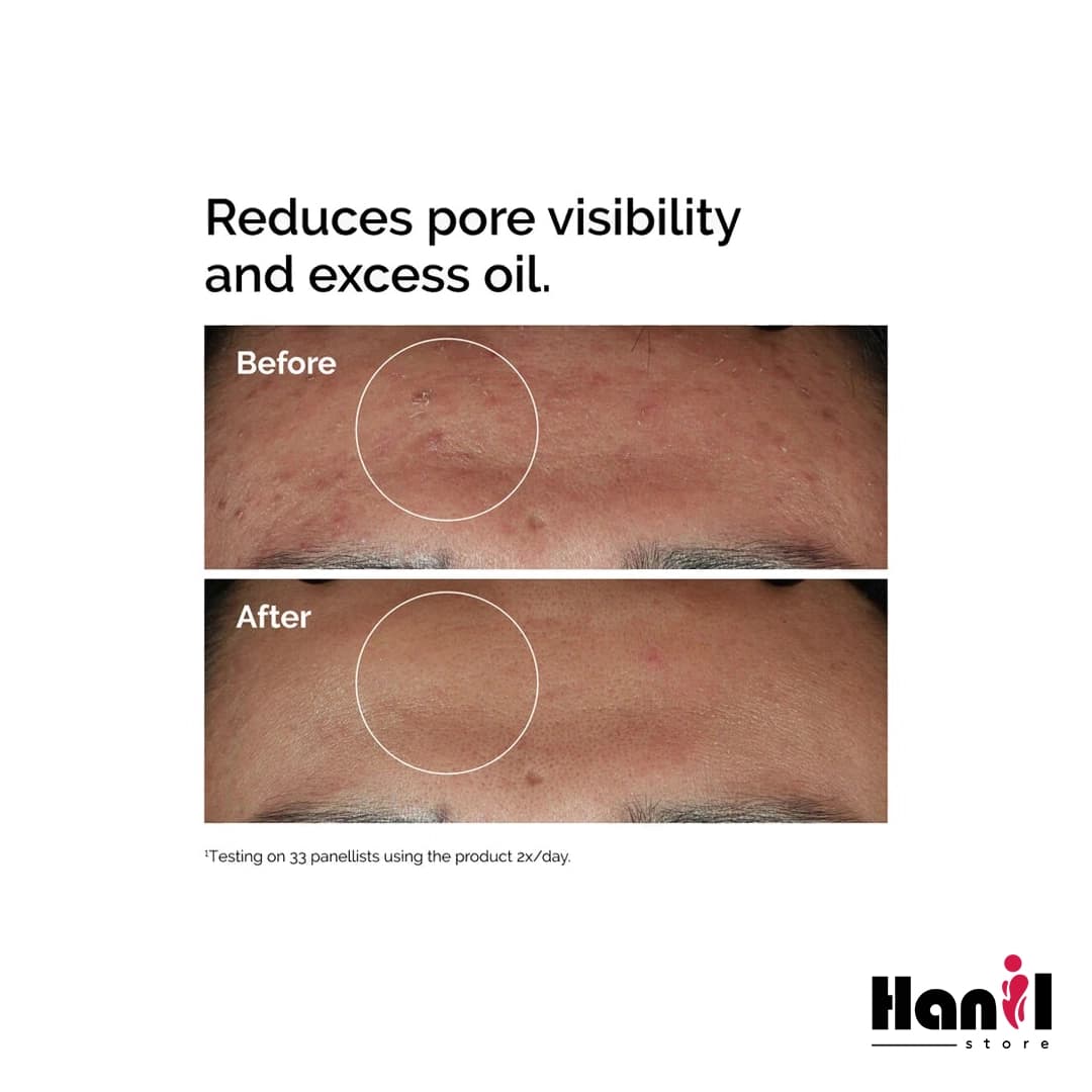 سرم نیاسینامید اوردینری 10% + زینک Niacinamide 10% + Zinc 1% — تصویر ۲
